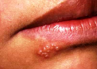 Herpes labialis - groznica na usnama